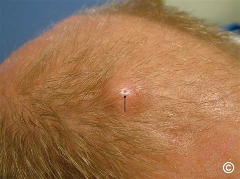 trichilemmal cysts pictures.